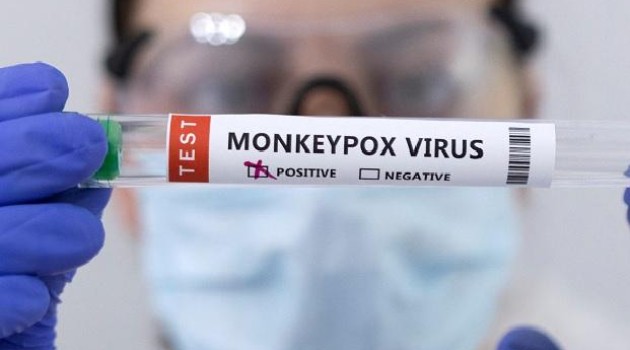 2 suspected monkeypox cases detected in Uri